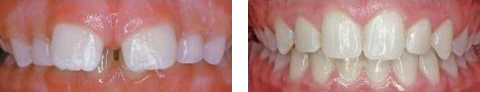 Overbite and Overjet Overbite and Overjet