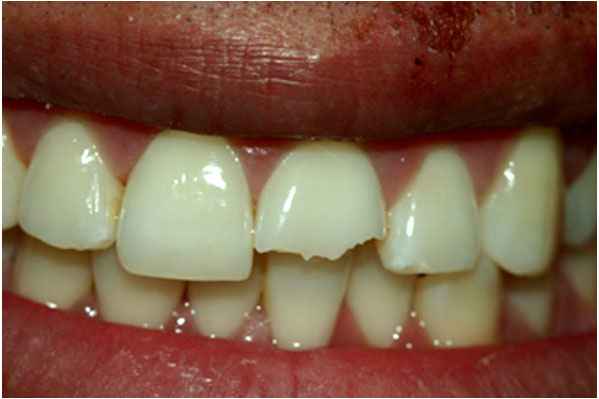 Dental Crowns Before